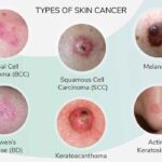 Skin Cancer : Types, Images, Causes, Symptoms and Treatment